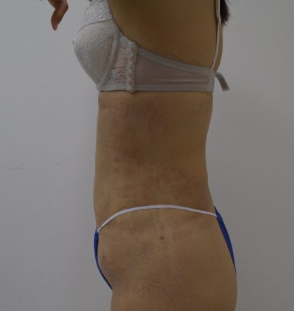 Lipo 360 Before & After Patient #1261