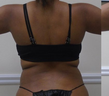 Lipo 360 Before & After Patient #1266