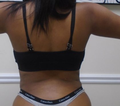Lipo 360 Before & After Patient #1266