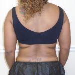 Lipo 360 Before & After Patient #1246