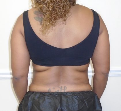 Lipo 360 Before & After Patient #1246