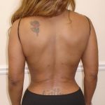 Lipo 360 Before & After Patient #1246