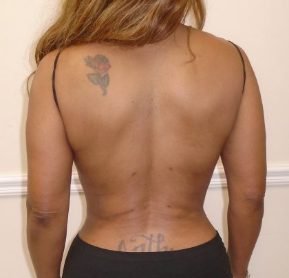 Lipo 360 Before & After Patient #1246