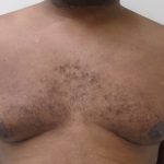 Gynecomastia Before & After Patient #1316