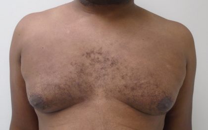 Gynecomastia Before & After Patient #1316