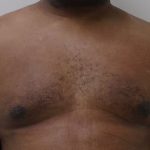 Gynecomastia Before & After Patient #1316