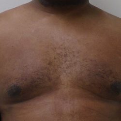 Gynecomastia Before & After Patient #1316