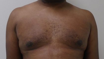 Gynecomastia Before & After Patient #1316