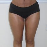 Inner Thigh Before & After Patient #1287