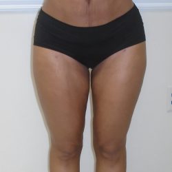 Inner Thigh Before & After Patient #1287