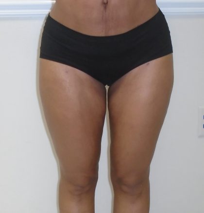 Inner Thigh Before & After Patient #1287