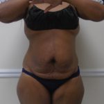 Lipo 360 Before & After Patient #1399