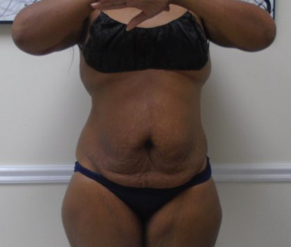 Lipo 360 Before & After Patient #1399