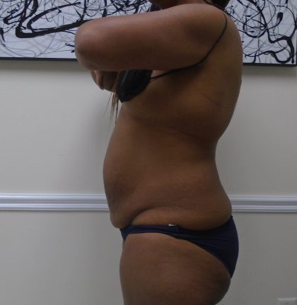 Lipo 360 Before & After Patient #1399