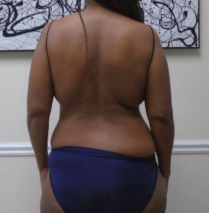 Lipo 360 Before & After Patient #1399