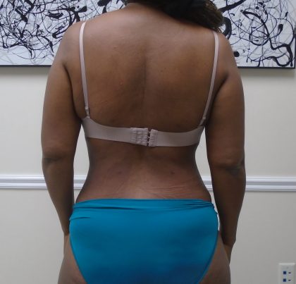 Lipo 360 Before & After Patient #1399