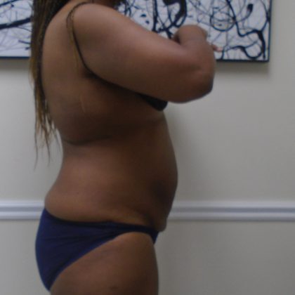 Lipo 360 Before & After Patient #1399