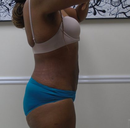 Lipo 360 Before & After Patient #1399
