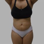 Lipo 360 Before & After Patient #1408