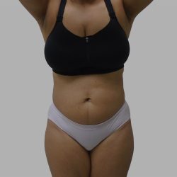 Lipo 360 Before & After Patient #1408