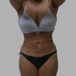 Lipo 360 Before & After Patient #1408
