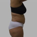 Lipo 360 Before & After Patient #1408