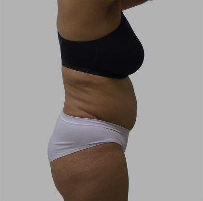 Lipo 360 Before & After Patient #1408