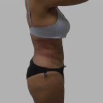 Lipo 360 Before & After Patient #1408