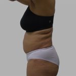 Lipo 360 Before & After Patient #1408
