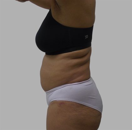 Lipo 360 Before & After Patient #1408
