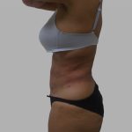 Lipo 360 Before & After Patient #1408