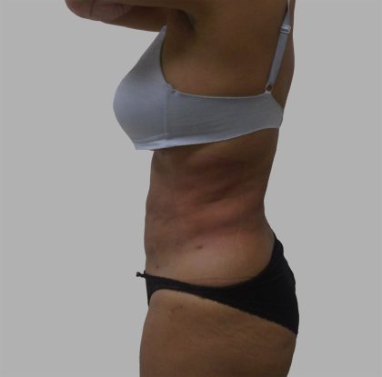 Lipo 360 Before & After Patient #1408
