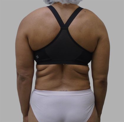 Lipo 360 Before & After Patient #1408