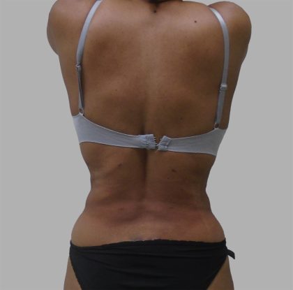 Lipo 360 Before & After Patient #1408