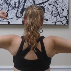 Arm Liposuction Before & After Patient #1450