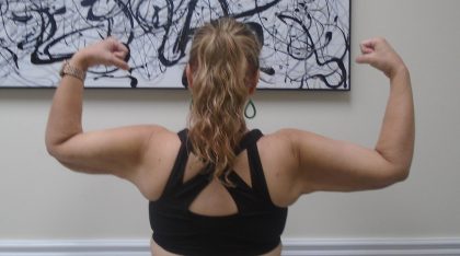 Arm Liposuction Before & After Patient #1450