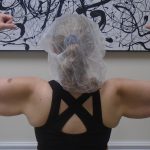 Arm Liposuction Before & After Patient #1450