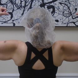 Arm Liposuction Before & After Patient #1450