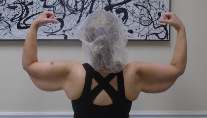 Arm Liposuction Before & After Patient #1450