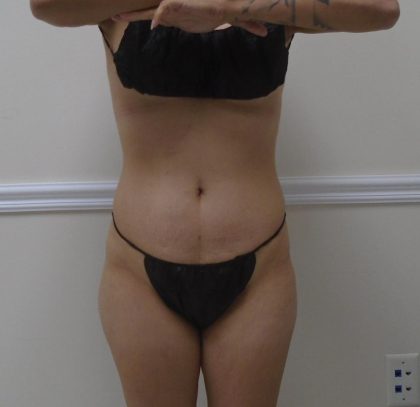 Lipo 360 Before & After Patient #1458