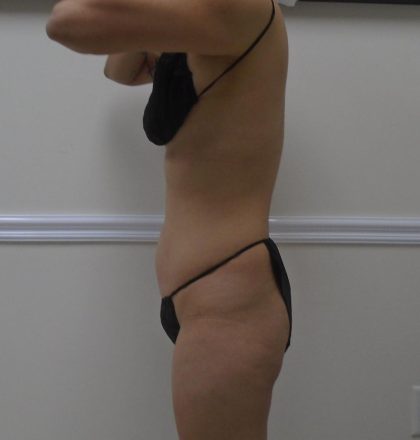 Lipo 360 Before & After Patient #1458