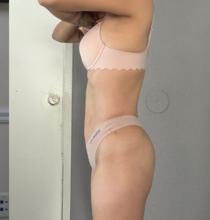 Lipo 360 Before & After Patient #1458