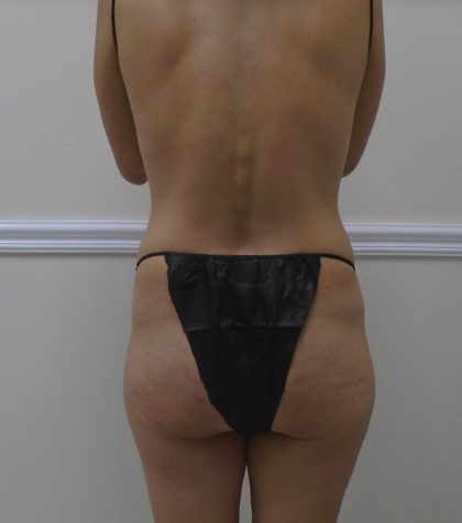 Lipo 360 Before & After Patient #1458