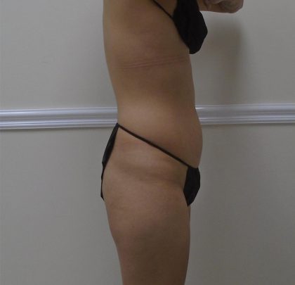 Lipo 360 Before & After Patient #1458